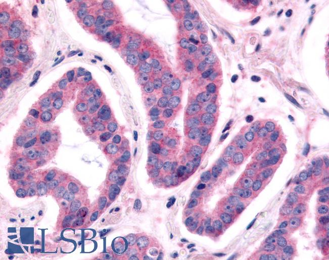 NEK9 Antibody - Prostate, Carcinoma