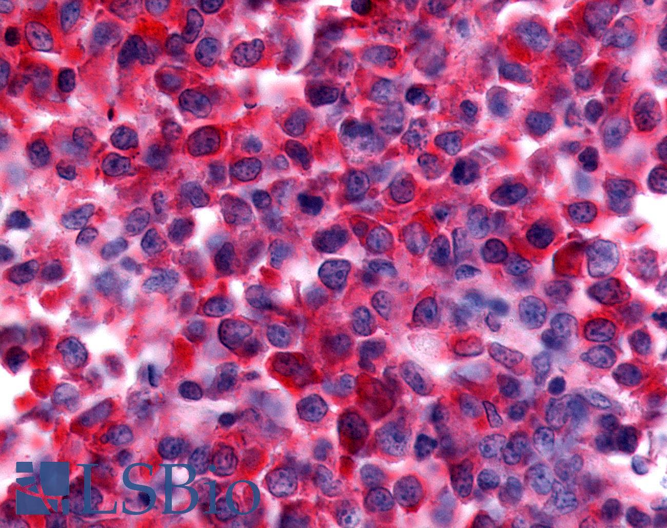 NEK9 Antibody - Non-Hodgkin's lymphoma