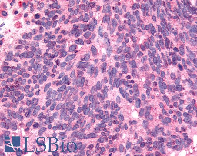 NEK9 Antibody - Lung, Small Cell Carcinoma