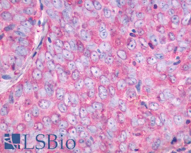 NMBR Antibody - Anti-NMBR antibody IHC of human Ovary, Carcinoma. Immunohistochemistry of formalin-fixed, paraffin-embedded tissue after heat-induced antigen retrieval.