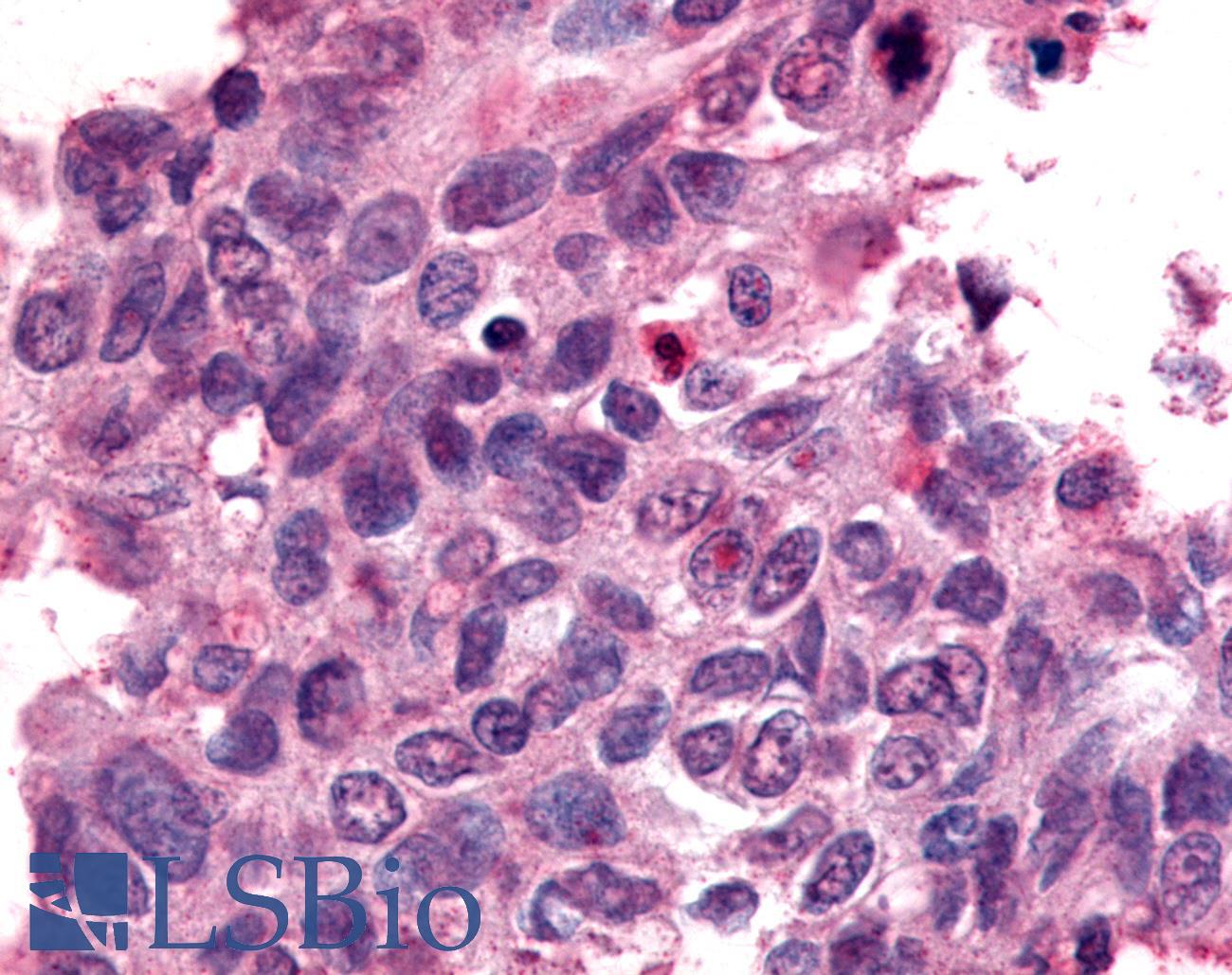 Nor-1 / NR4A3 Antibody - Ovary, Carcinoma