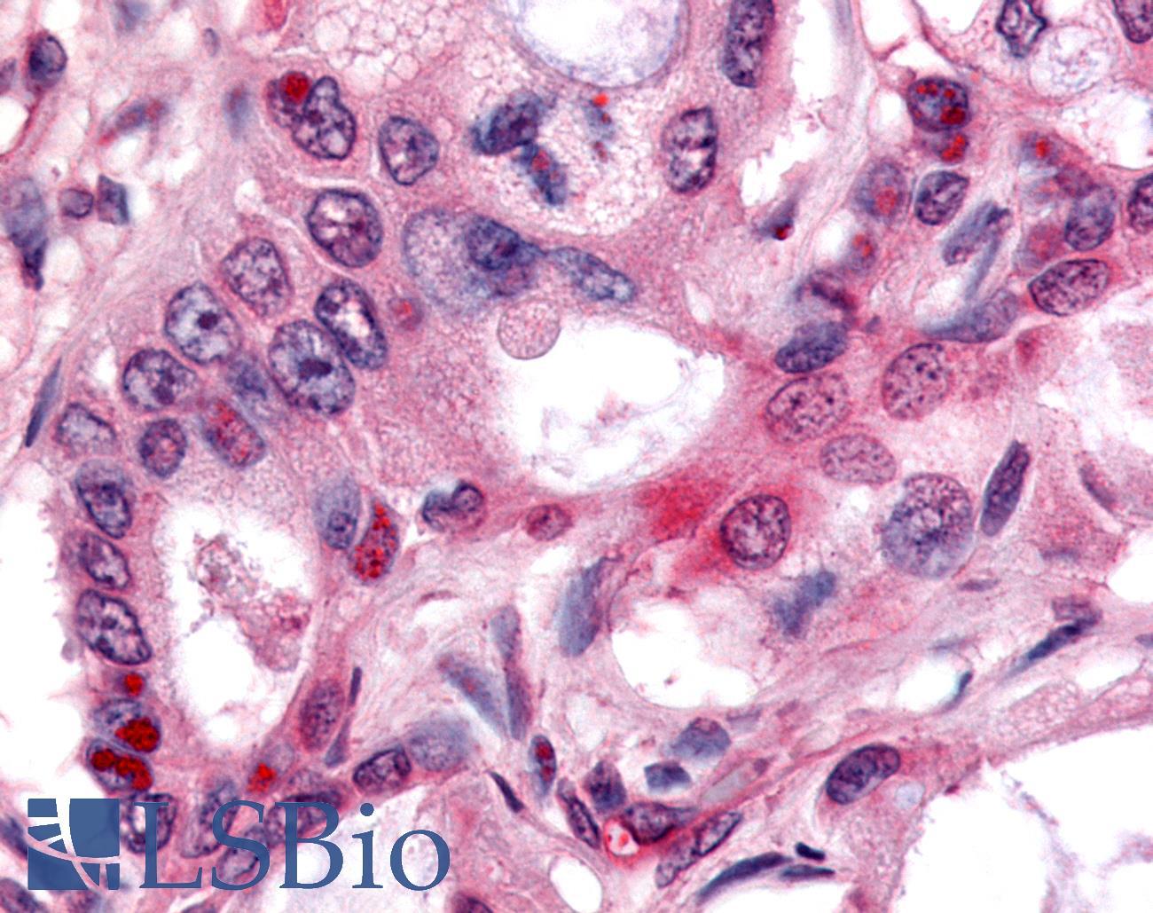 Nor-1 / NR4A3 Antibody - Pancreas, carcinoma
