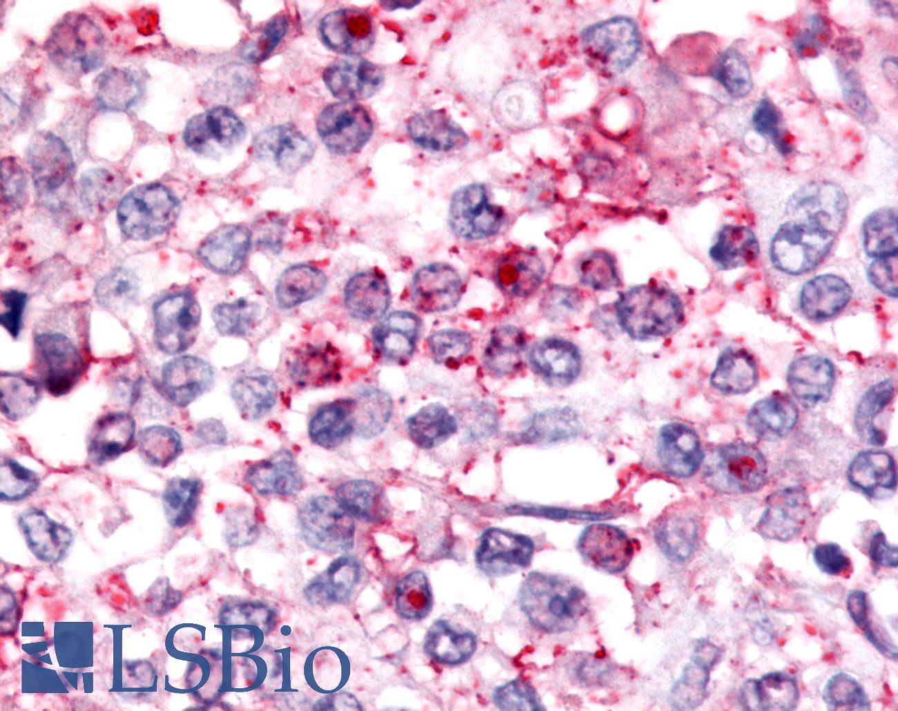 Nor-1 / NR4A3 Antibody - Anti-Nor-1 / NR4A3 antibody IHC of human Breast, Carcinoma. Immunohistochemistry of formalin-fixed, paraffin-embedded tissue after heat-induced antigen retrieval.