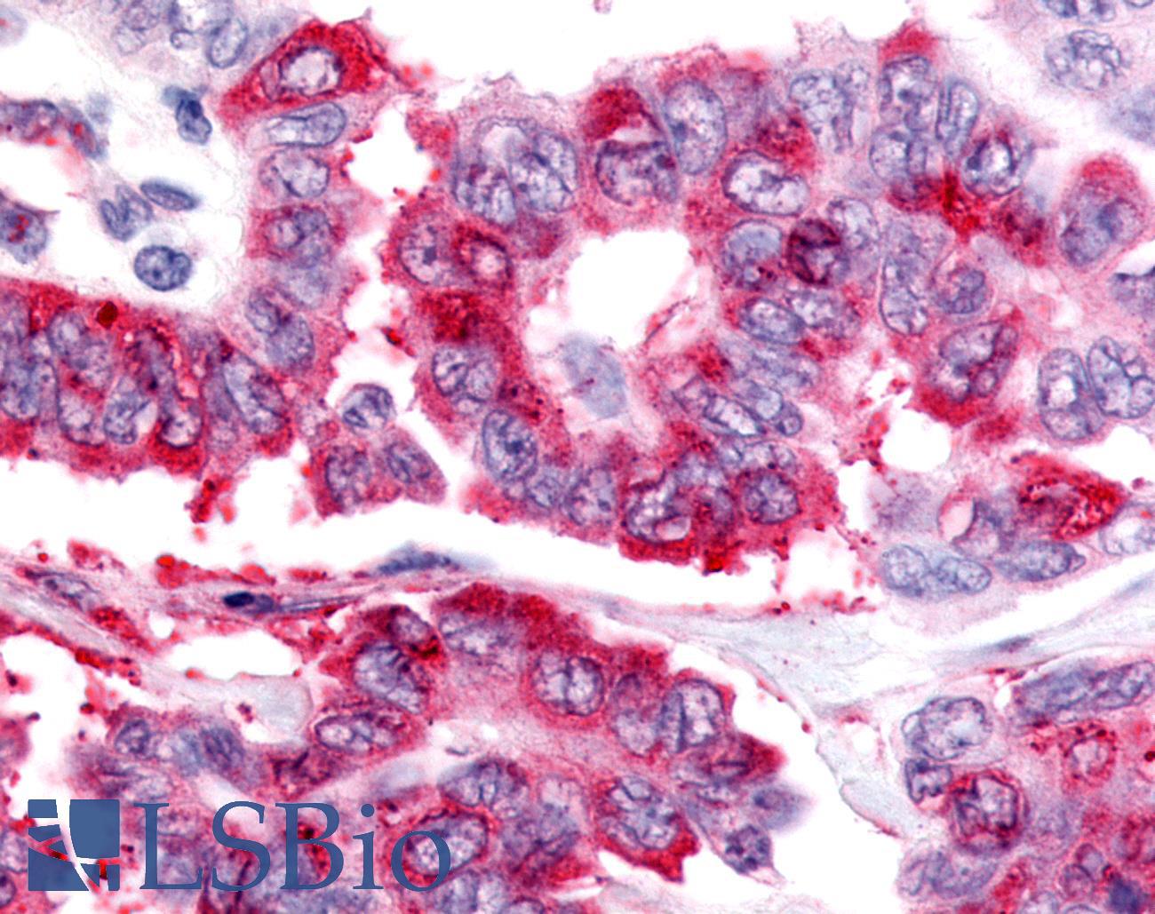 Nor-1 / NR4A3 Antibody - Lung, Non Small-Cell Carcinoma