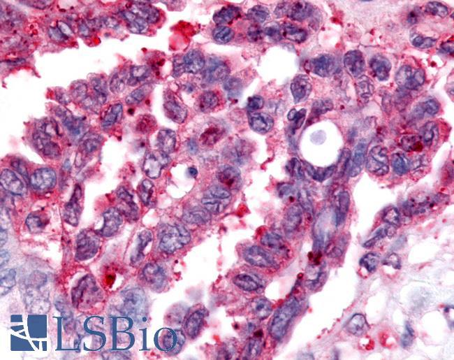 Nor-1 / NR4A3 Antibody - Ovary, Carcinoma