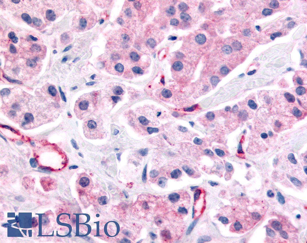 Nor-1 / NR4A3 Antibody - Prostate, Carcinoma