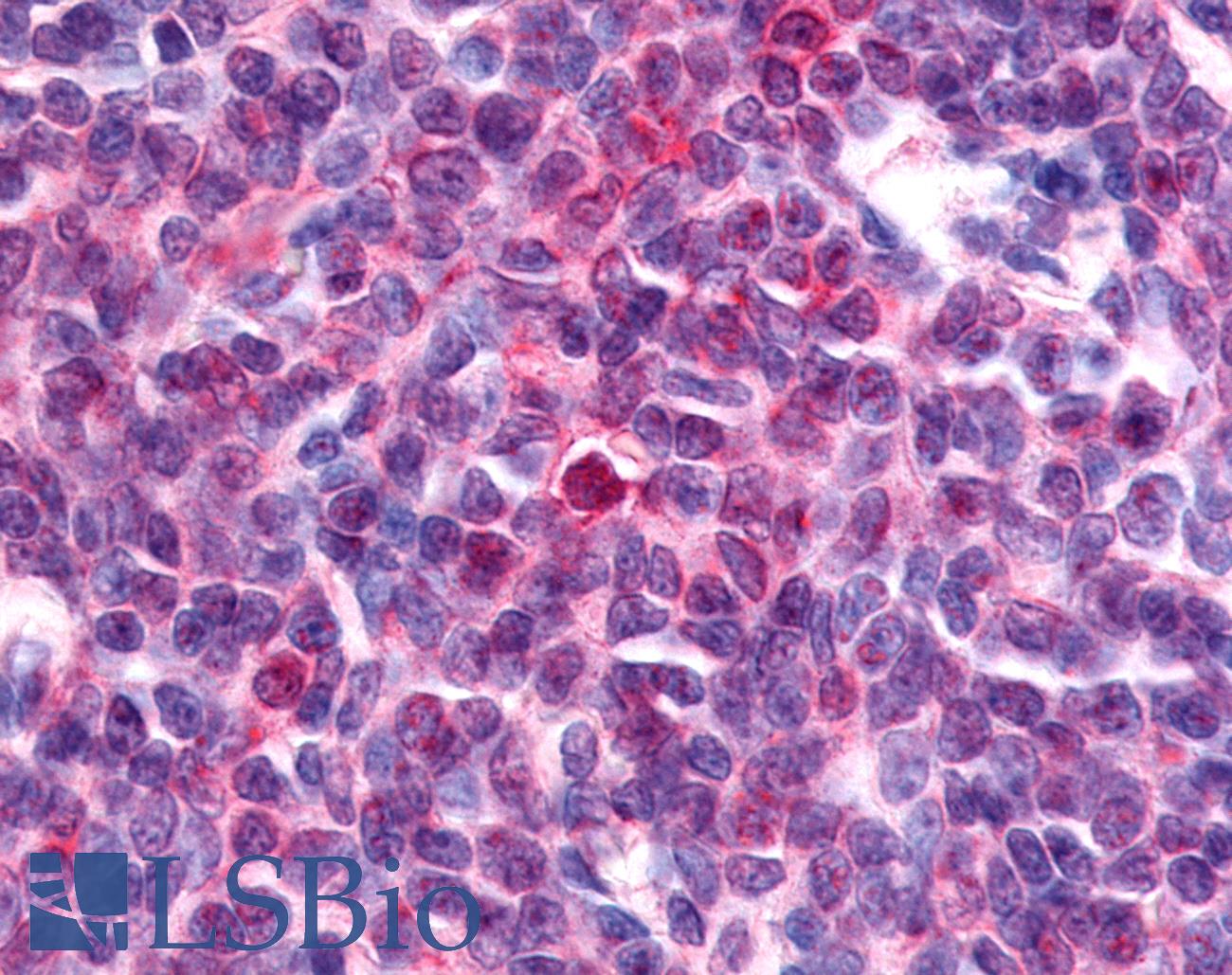 Nor-1 / NR4A3 Antibody - Anti-Nor-1 / NR4A3 antibody IHC of human Lymph Node, Non-Hodgkins Lymphoma. Immunohistochemistry of formalin-fixed, paraffin-embedded tissue after heat-induced antigen retrieval.