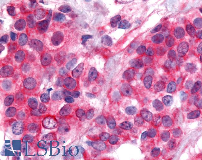 Nor-1 / NR4A3 Antibody - Breast, carcinoma