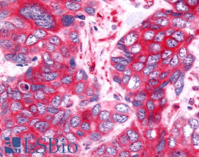 Nor-1 / NR4A3 Antibody - Colon, Carcinoma