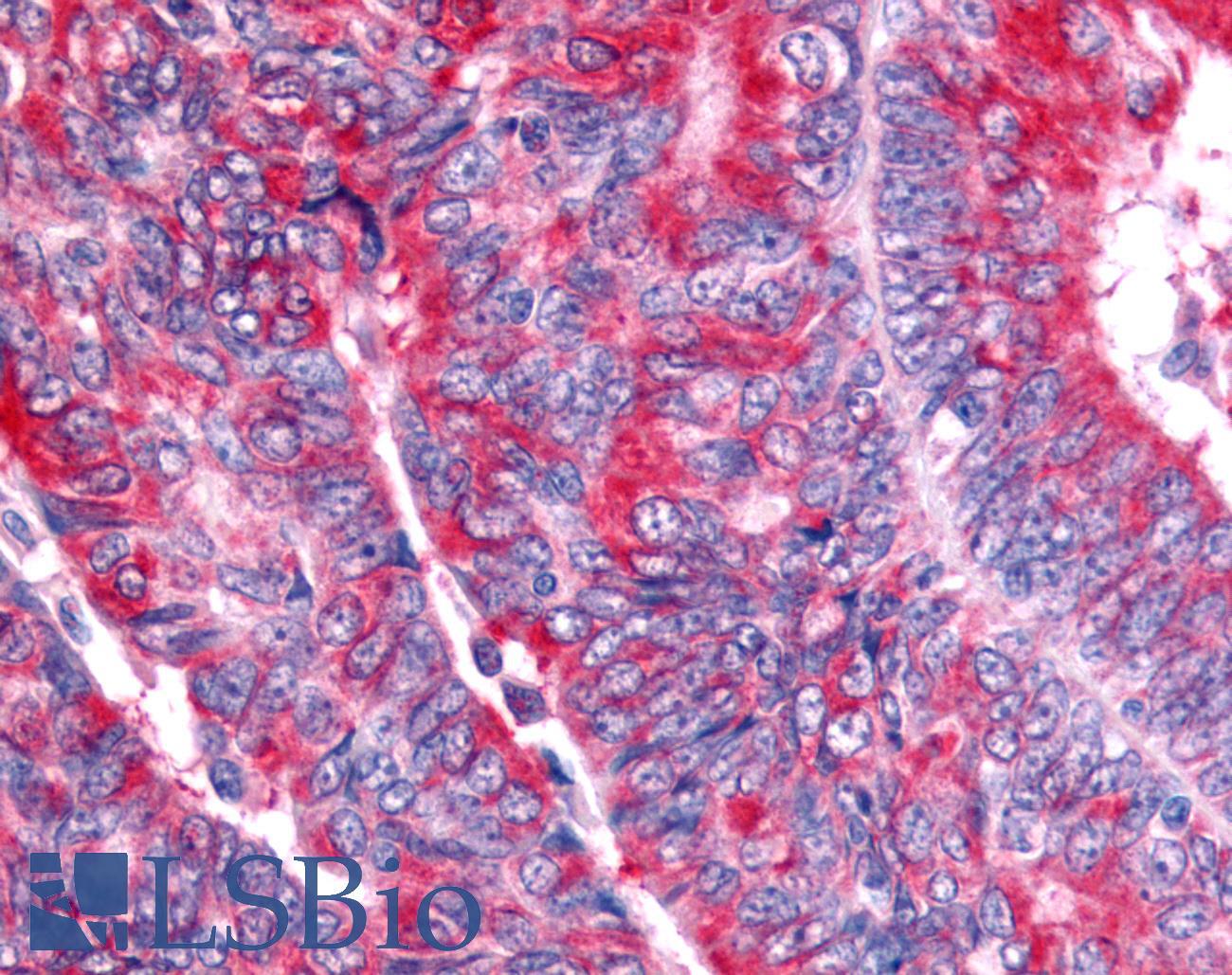 Nor-1 / NR4A3 Antibody - Ovary, carcinoma