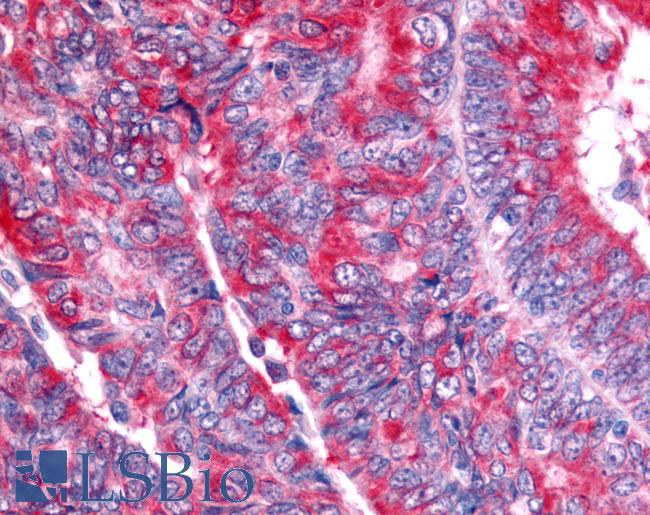 Nor-1 / NR4A3 Antibody - Ovary, carcinoma