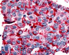NPBWR2 / GPR8 Antibody - Anti-NPBWR2 / GPR8 antibody IHC of human Lung, Non-Small Cell Carcinoma. Immunohistochemistry of formalin-fixed, paraffin-embedded tissue after heat-induced antigen retrieval.