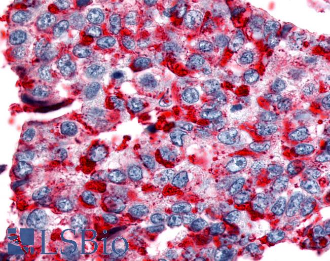 NPBWR2 / GPR8 Antibody - Anti-NPBWR2 / GPR8 antibody IHC of human Lung, Non-Small Cell Carcinoma. Immunohistochemistry of formalin-fixed, paraffin-embedded tissue after heat-induced antigen retrieval.