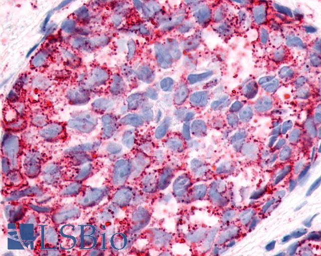 NPFFR1 / GPR147 Antibody - Anti-NPFFR1 / GPR147 antibody IHC of human Breast, Carcinoma. Immunohistochemistry of formalin-fixed, paraffin-embedded tissue after heat-induced antigen retrieval.