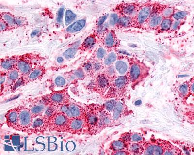 NPFFR1 / GPR147 Antibody - Breast, Carcinoma