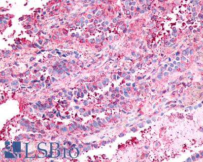 NPFFR1 / GPR147 Antibody - Lung, adenocarcinoma