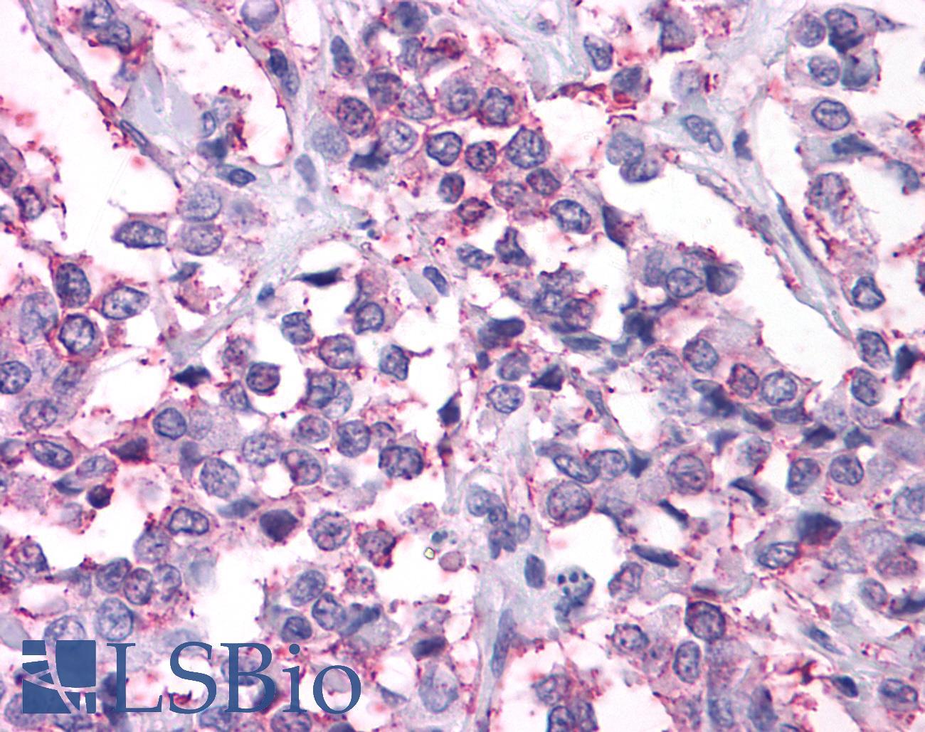 NPY2R Antibody - Breast, carcinoma