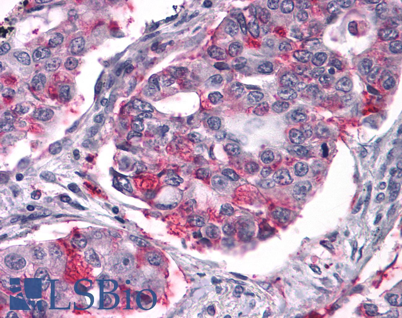 NPY2R Antibody - Lung, Non Small-Cell Carcinoma