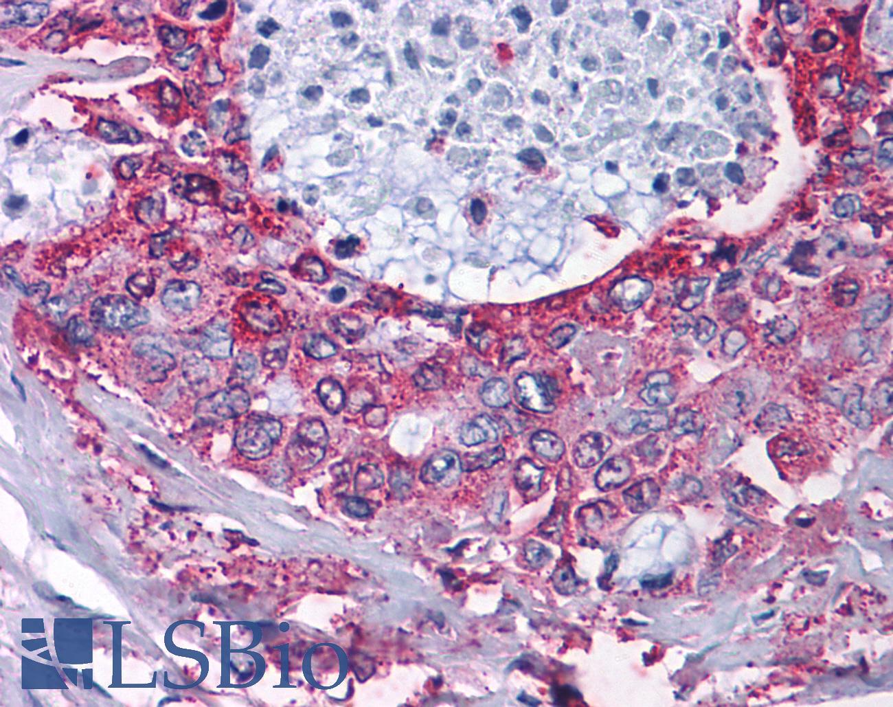 NPY2R Antibody - Pancreas, carcinoma