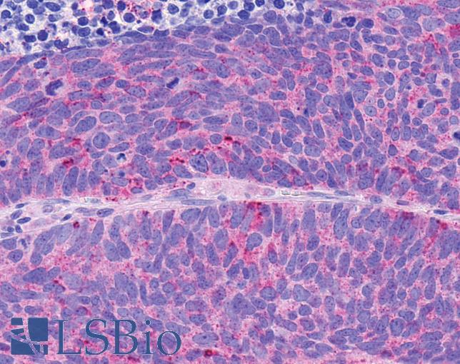 NPY4R / PPYR1 Antibody - Anti-NPY4R / PPYR1 antibody IHC of human Lung, Small Cell Carcinoma. Immunohistochemistry of formalin-fixed, paraffin-embedded tissue after heat-induced antigen retrieval.
