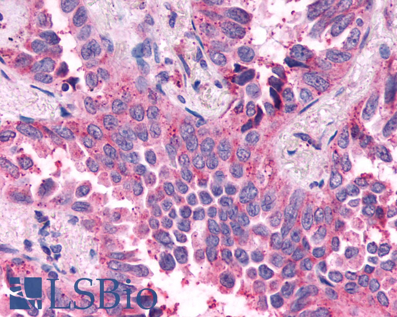 NPY4R / PPYR1 Antibody - Lung, Non Small-Cell Carcinoma