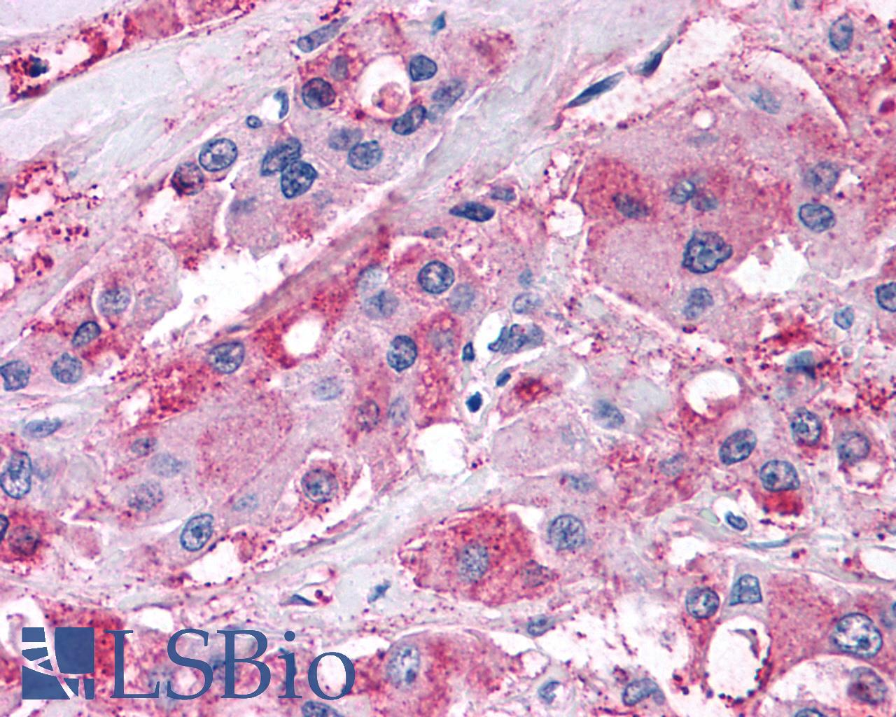 NPY5R Antibody - Breast, carcinoma