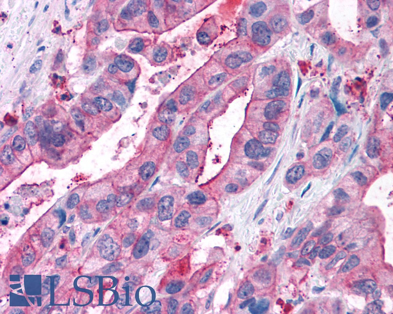 NPY5R Antibody - Colon, Carcinoma