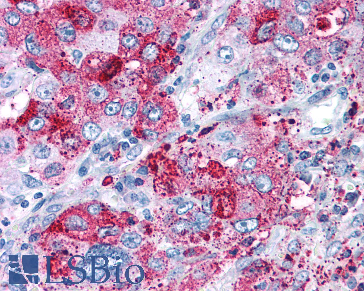 NPY5R Antibody - Lung, Non Small-Cell Carcinoma