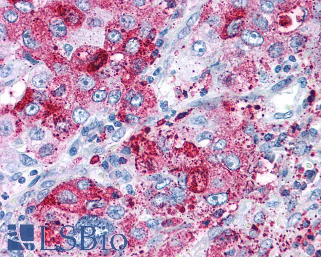 NPY5R Antibody - Lung, Non Small-Cell Carcinoma