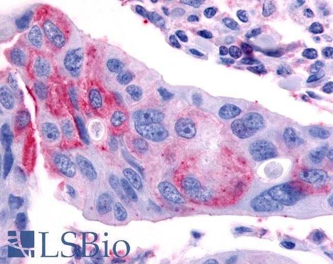 NR0B2 Antibody - Breast, carcinoma