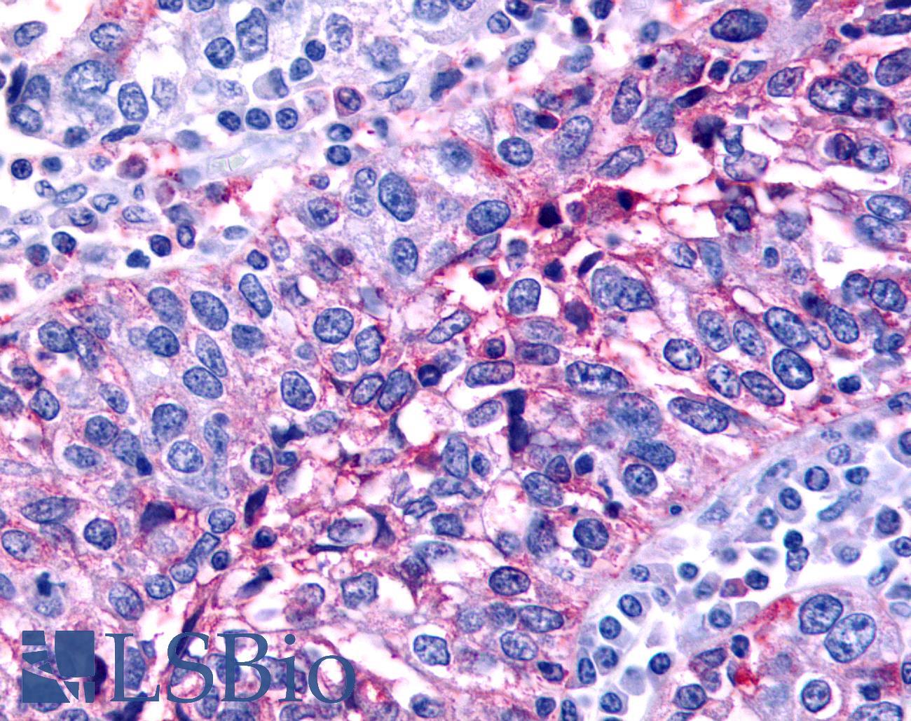 NR0B2 Antibody - Ovary, carcinoma