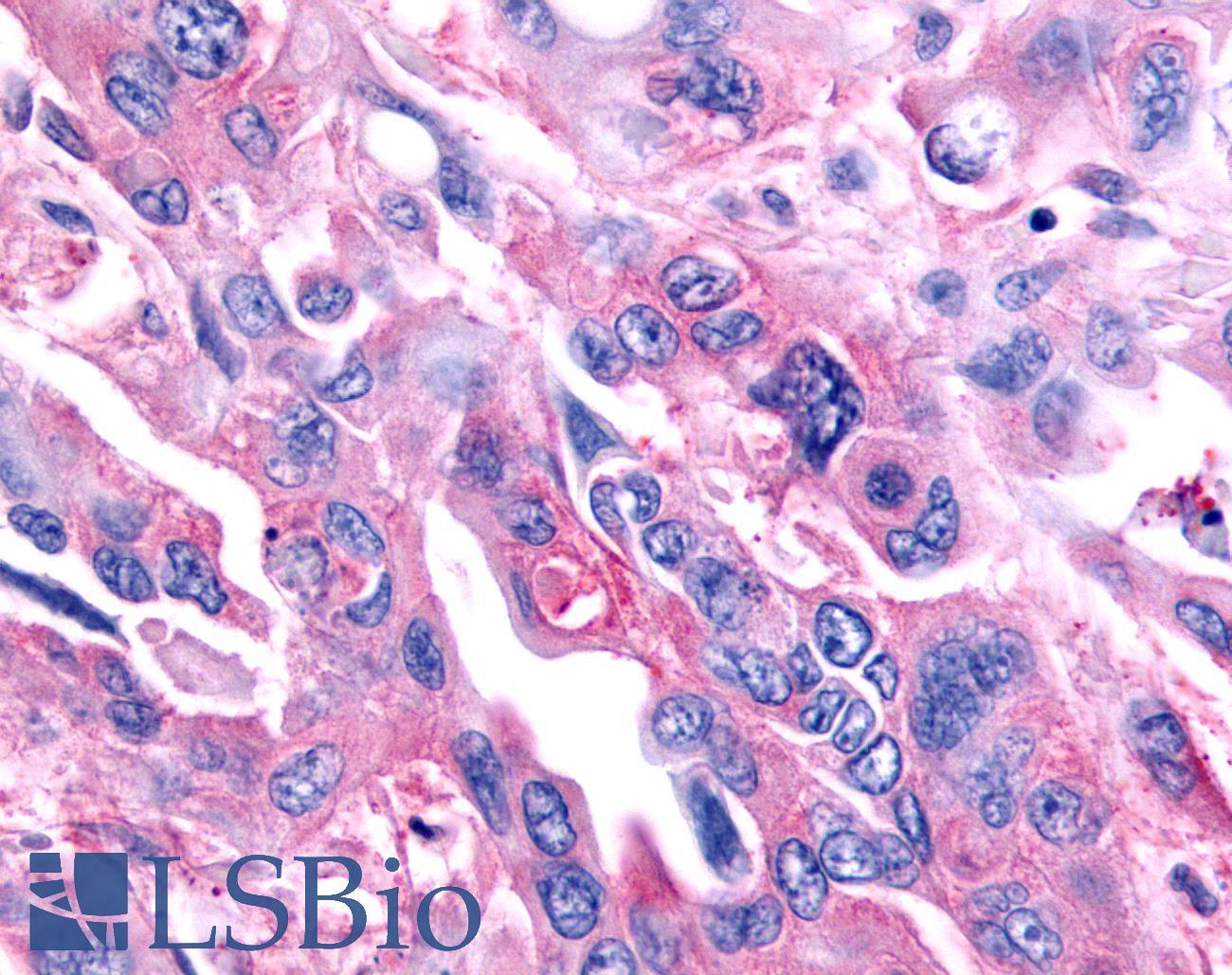 NR0B2 Antibody - Pancreas, carcinoma