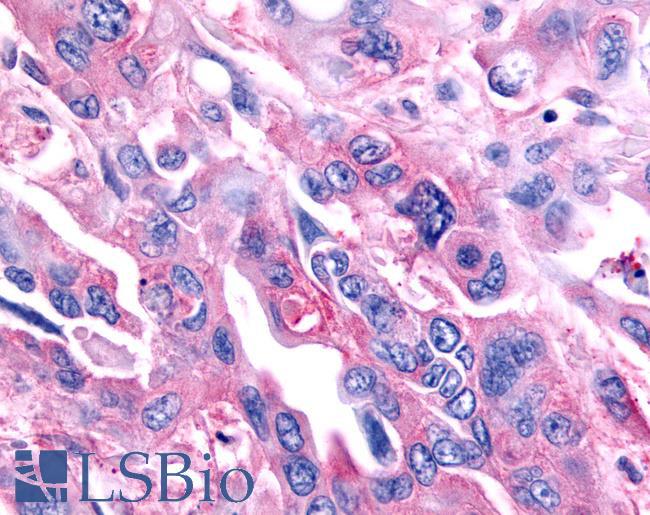 NR0B2 Antibody - Pancreas, carcinoma