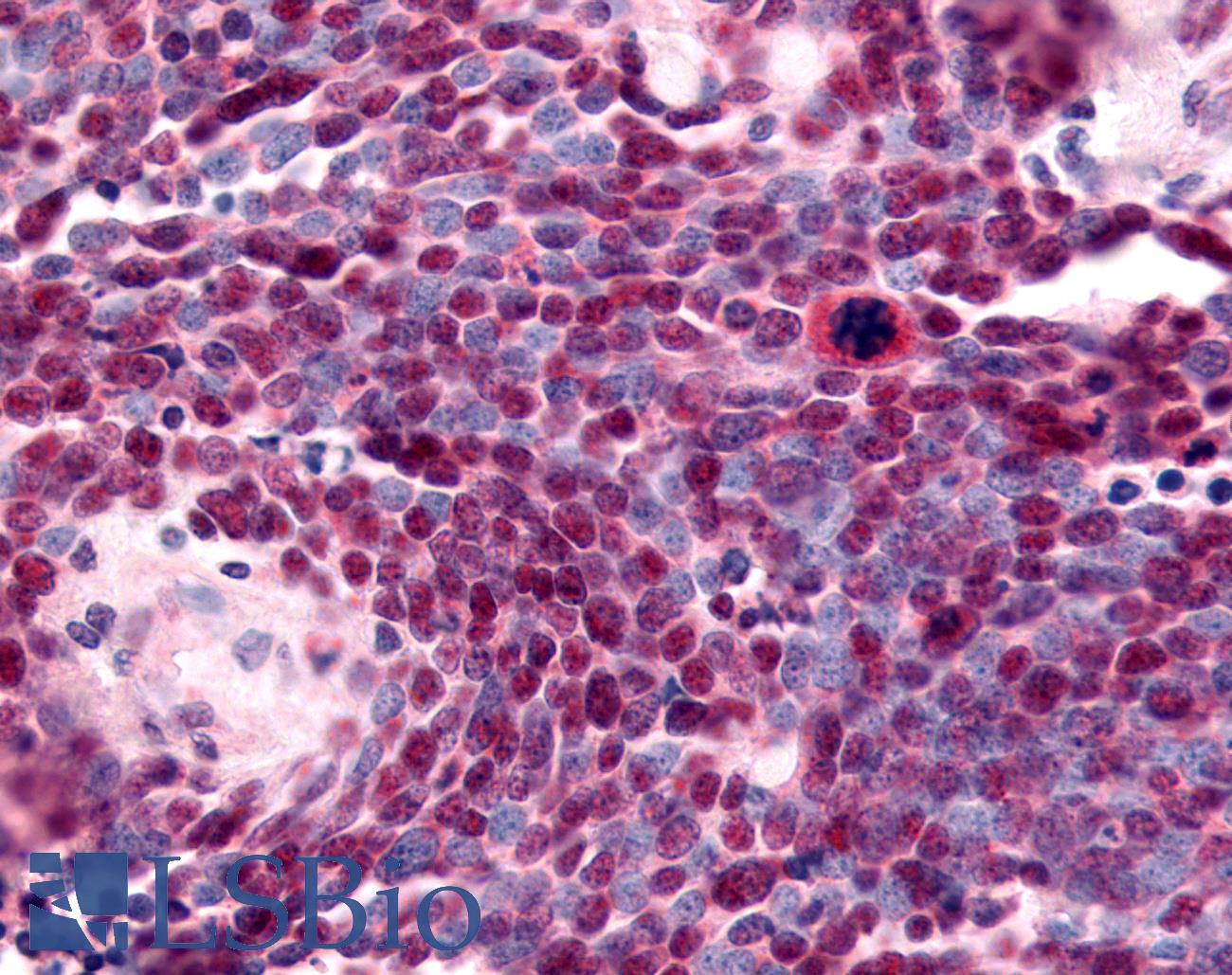 NR2E1 / TLX Antibody - Anti-NR2E1 / TLX antibody IHC of human Lung, Small Cell Carcinoma. Immunohistochemistry of formalin-fixed, paraffin-embedded tissue after heat-induced antigen retrieval.