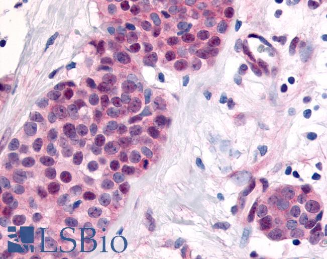 NR2E1 / TLX Antibody - Anti-NR2E1 / TLX antibody IHC of human Breast, Carcinoma. Immunohistochemistry of formalin-fixed, paraffin-embedded tissue after heat-induced antigen retrieval.