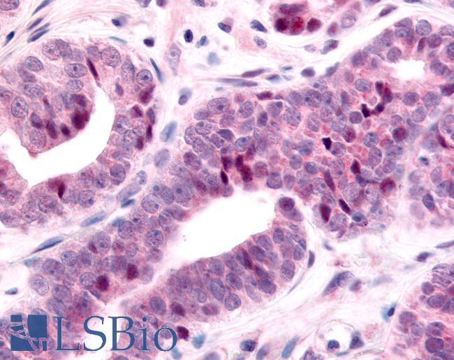 NR2E1 / TLX Antibody - Prostate, Carcinoma