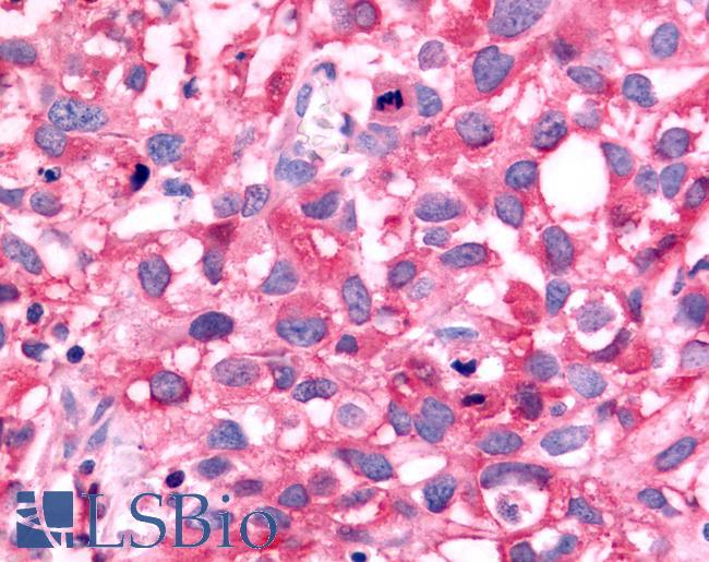 NR5A2 / LRH-1 Antibody - Breast, Carcinoma