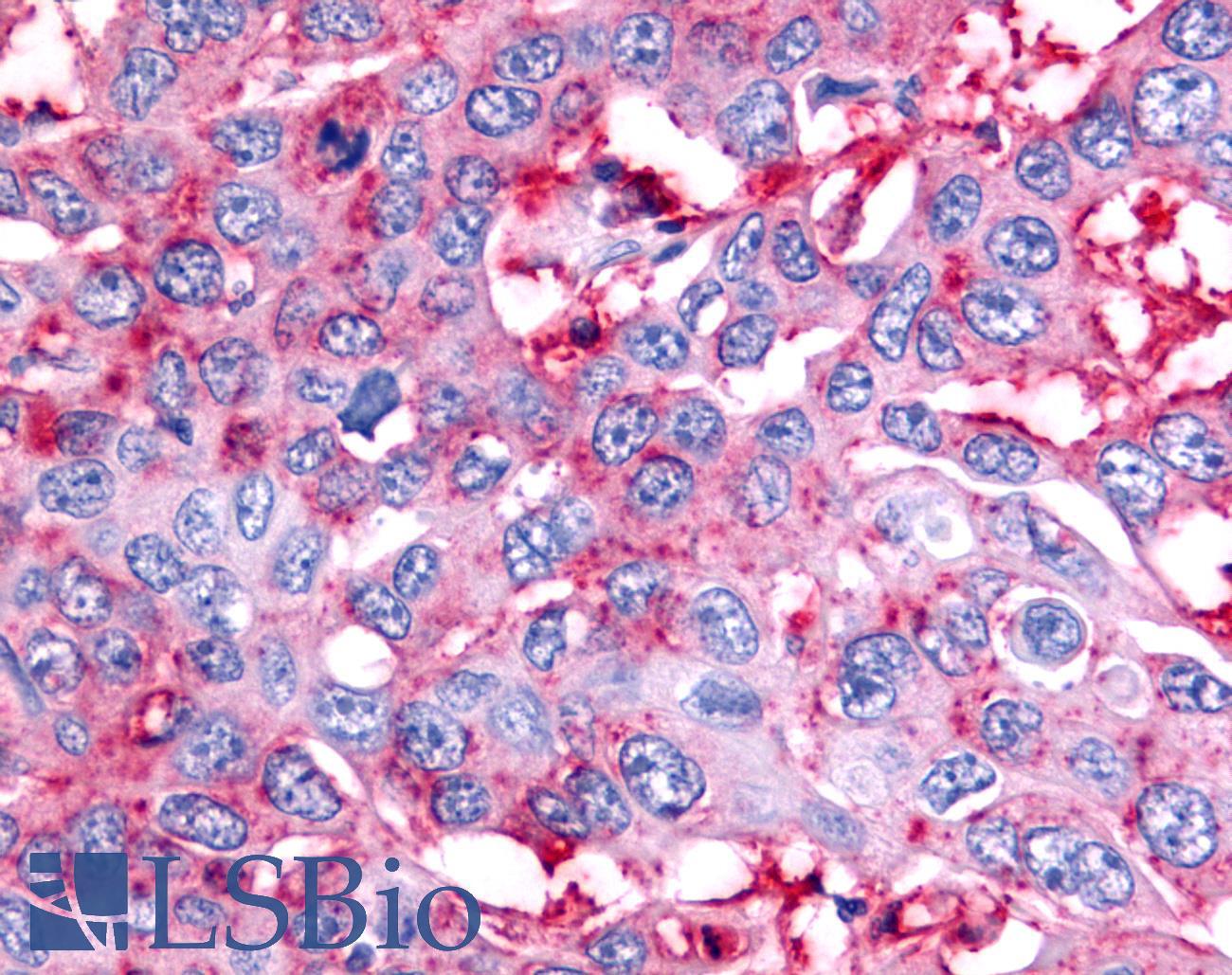 NR5A2 / LRH-1 Antibody - Colon, Carcinoma