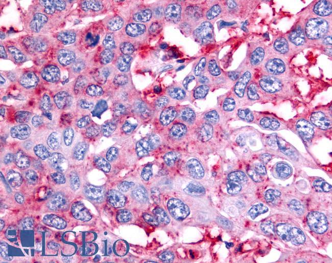 NR5A2 / LRH-1 Antibody - Colon, Carcinoma