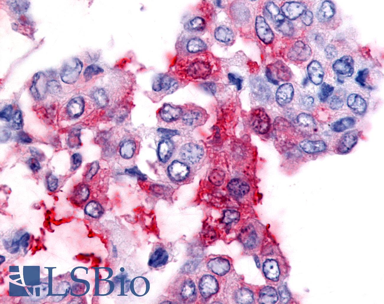 NR5A2 / LRH-1 Antibody - Lung, Non Small-Cell Carcinoma