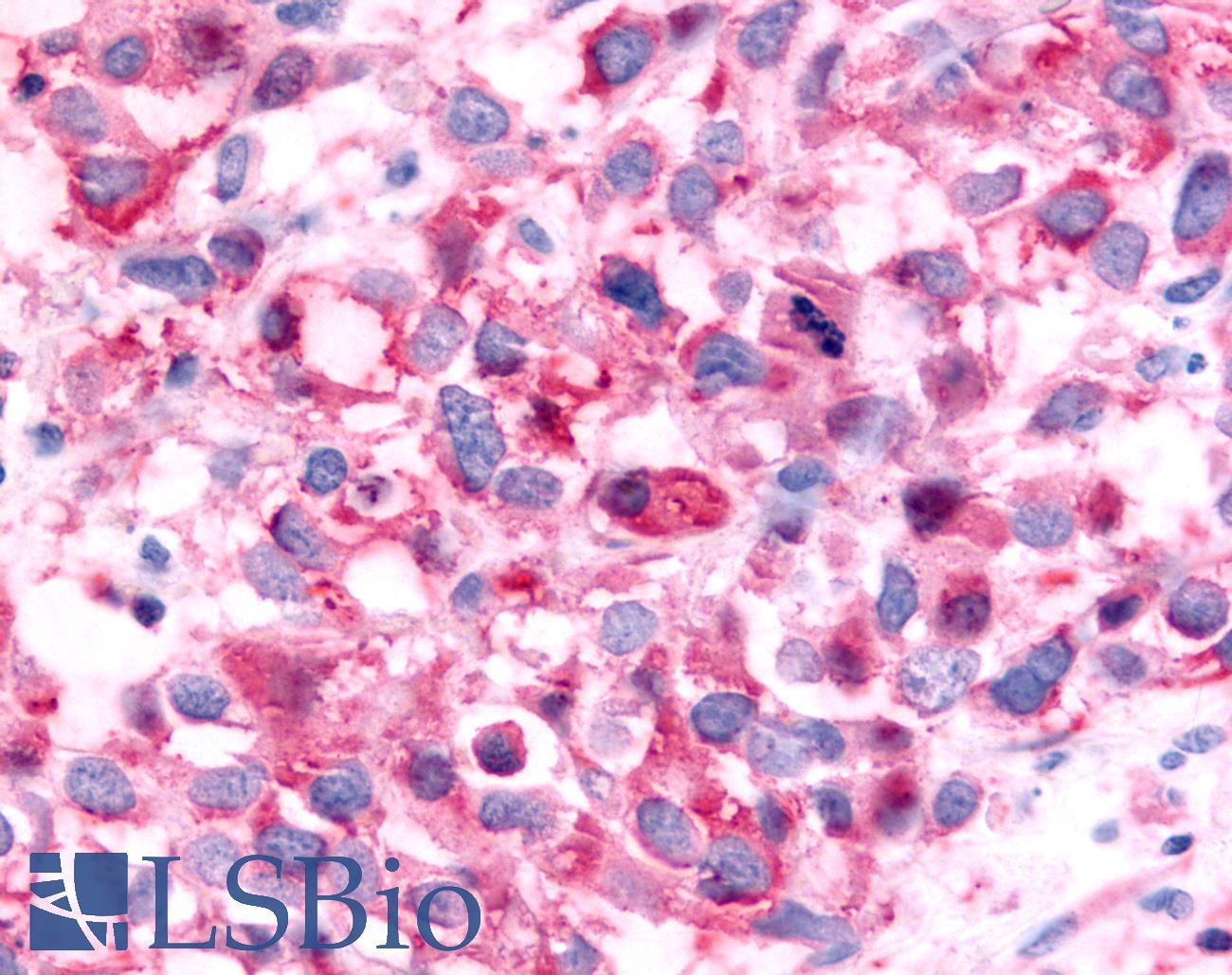 NR6A1 / GCNF Antibody - Breast, carcinoma