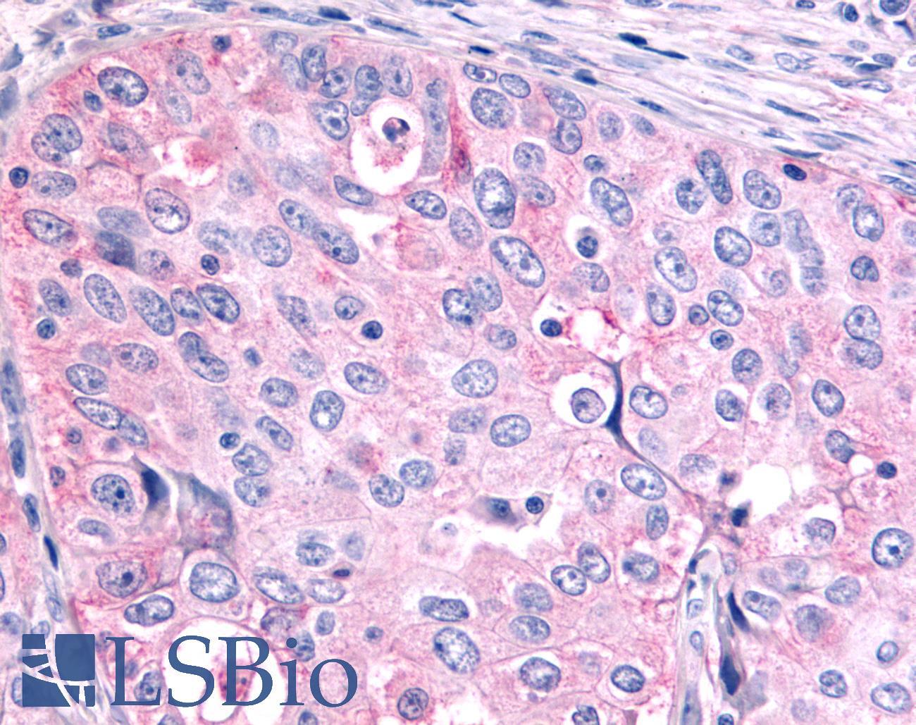 NR6A1 / GCNF Antibody - Ovary, carcinoma