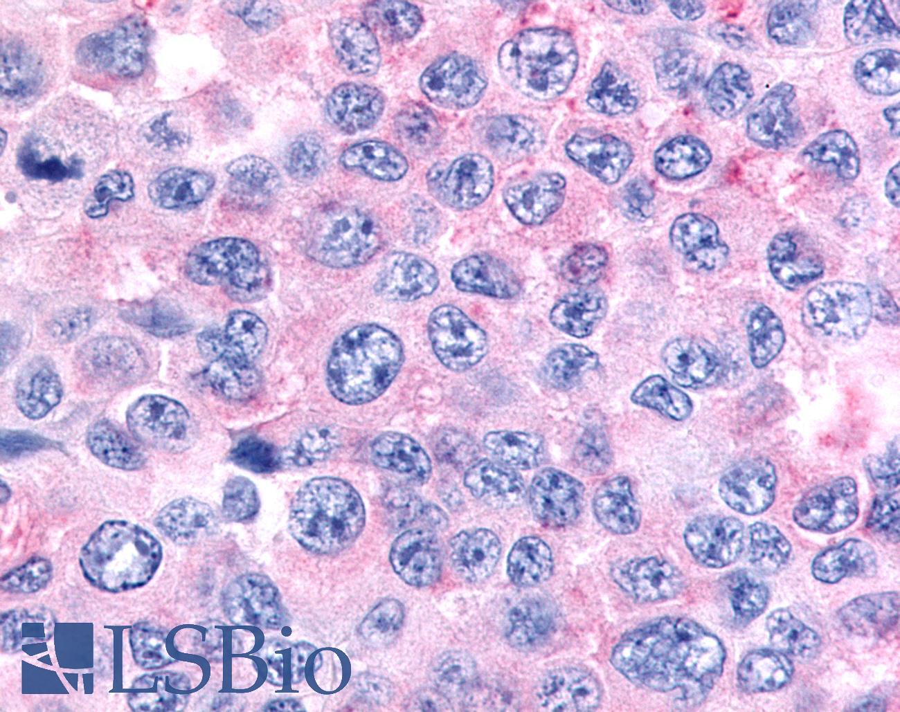 NR6A1 / GCNF Antibody - Skin, Melanoma