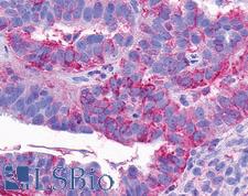 NTSR2 / NTR2 Antibody - Anti-NTSR2 / NTR2 antibody IHC of human Ovary, Carcinoma. Immunohistochemistry of formalin-fixed, paraffin-embedded tissue after heat-induced antigen retrieval.