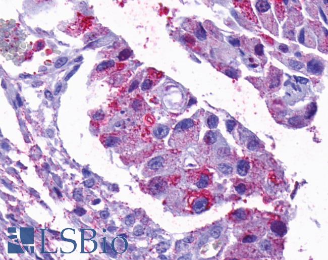 OPN5 / Neuropsin Antibody - Anti-OPN5 antibody IHC of human Ovary, Carcinoma. Immunohistochemistry of formalin-fixed, paraffin-embedded tissue after heat-induced antigen retrieval.
