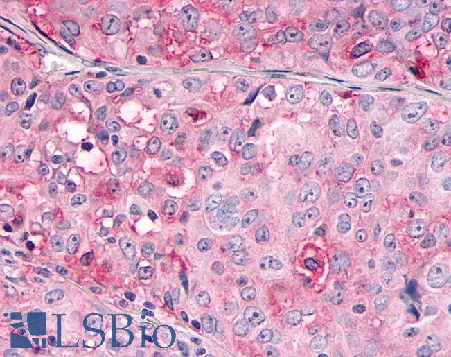 OR10R2 Antibody - Anti-OR10R2 antibody IHC of human Ovary, Carcinoma. Immunohistochemistry of formalin-fixed, paraffin-embedded tissue after heat-induced antigen retrieval.