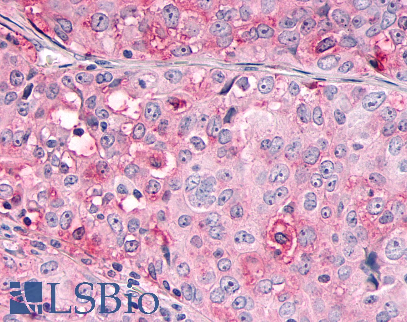 OR10R2 Antibody - Anti-OR10R2 antibody IHC of human Ovary, Carcinoma. Immunohistochemistry of formalin-fixed, paraffin-embedded tissue after heat-induced antigen retrieval.
