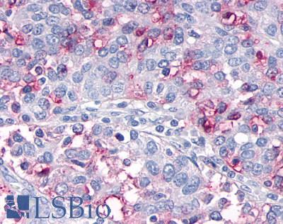 OR10R2 Antibody - Ovary, carcinoma