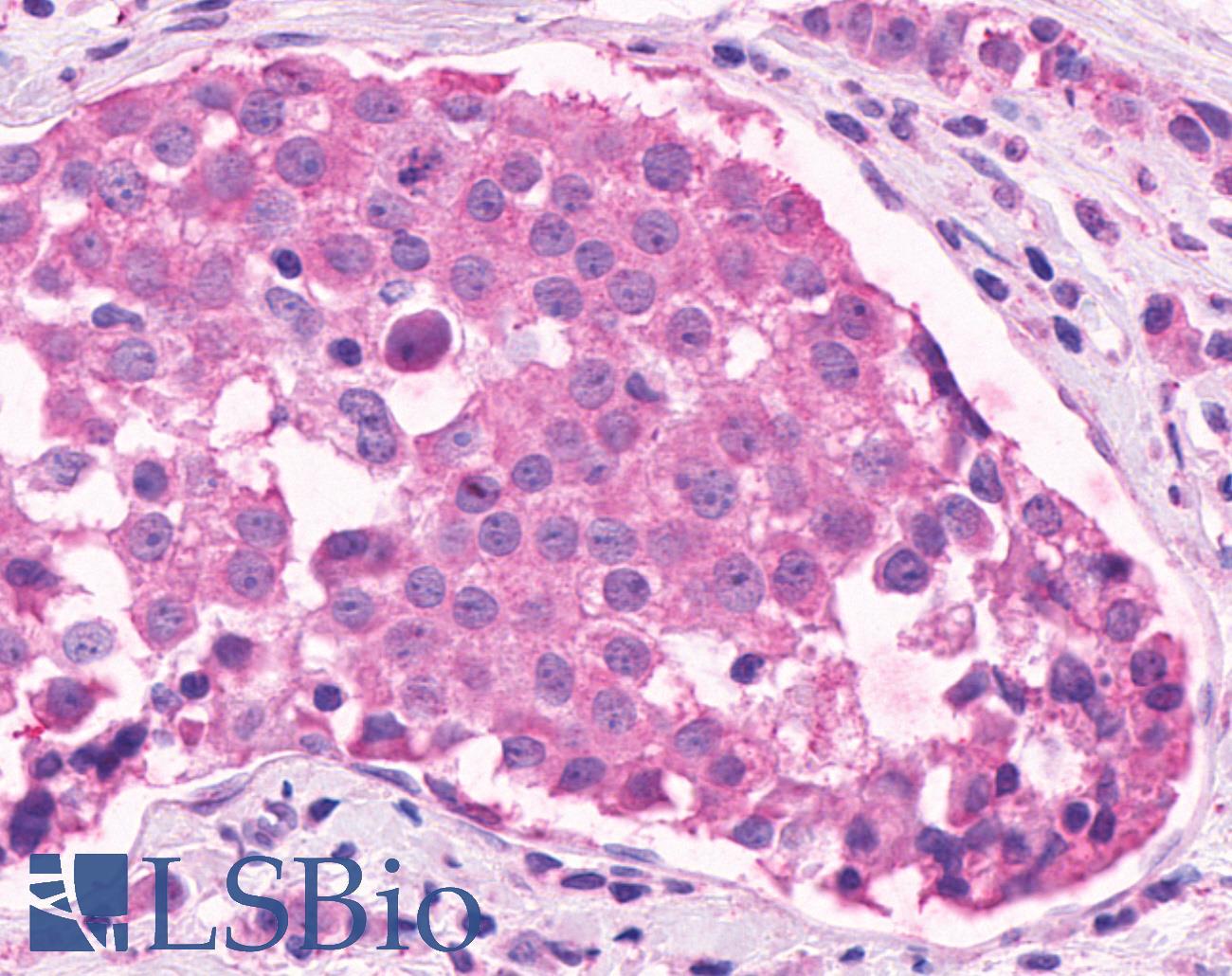 OR2A4 Antibody - Breast, Carcinoma