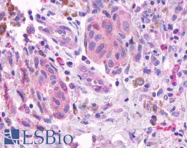 OR2A4 Antibody - Anti-OR2A4 antibody IHC of human Skin, Melanoma. Immunohistochemistry of formalin-fixed, paraffin-embedded tissue after heat-induced antigen retrieval.